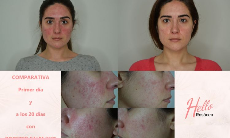 ¡Vivir con rosácea!